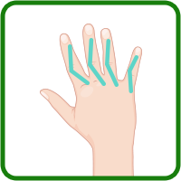 関節リウマチによる手関節、手指変形